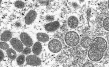 México confirma primer caso importado de viruela símica